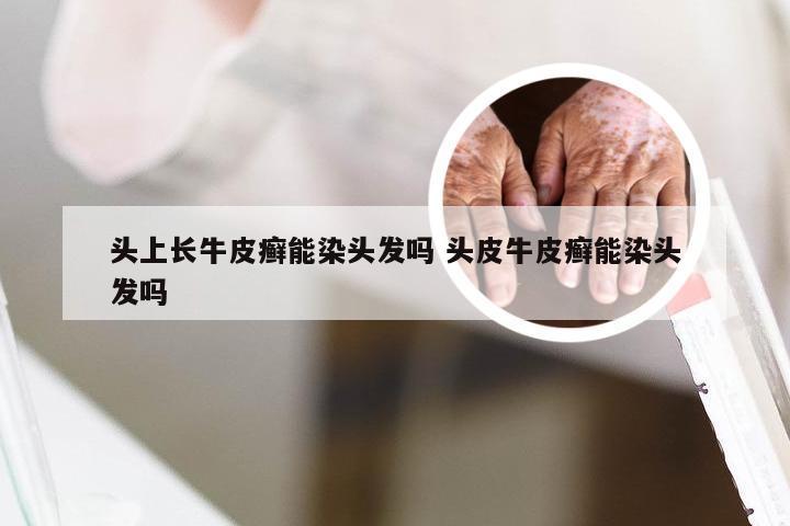 头上长牛皮癣能染头发吗 头皮牛皮癣能染头发吗