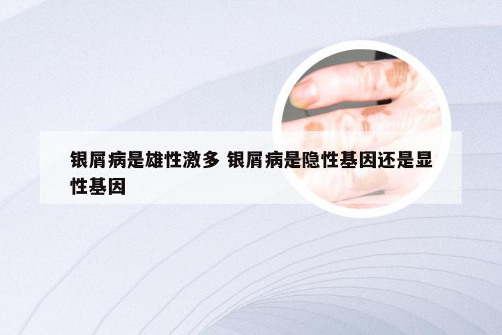银屑病是雄性激多 银屑病是隐性基因还是显性基因
