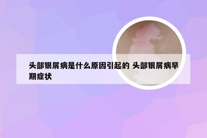 头部银屑病是什么原因引起的 头部银屑病早期症状