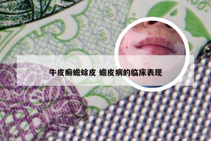 牛皮癣蟾蜍皮 蟾皮病的临床表现