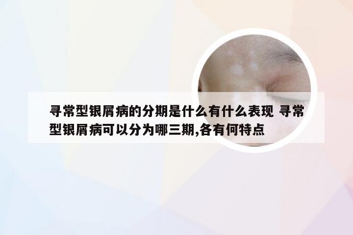 寻常型银屑病的分期是什么有什么表现 寻常型银屑病可以分为哪三期,各有何特点