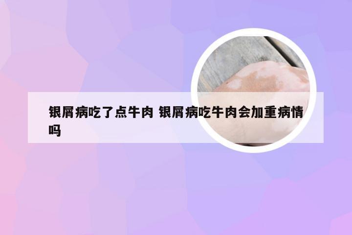 银屑病吃了点牛肉 银屑病吃牛肉会加重病情吗