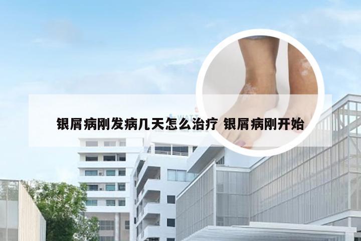 银屑病刚发病几天怎么治疗 银屑病刚开始