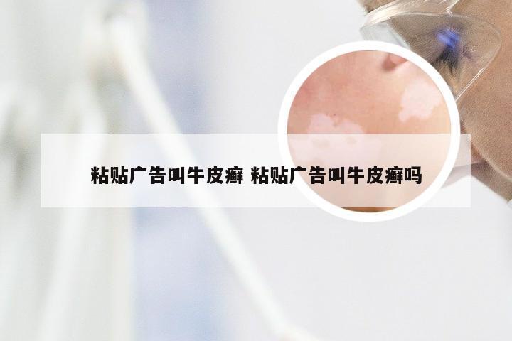 粘贴广告叫牛皮癣 粘贴广告叫牛皮癣吗