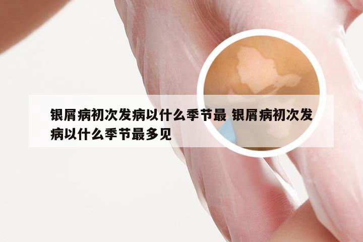 银屑病初次发病以什么季节最 银屑病初次发病以什么季节最多见