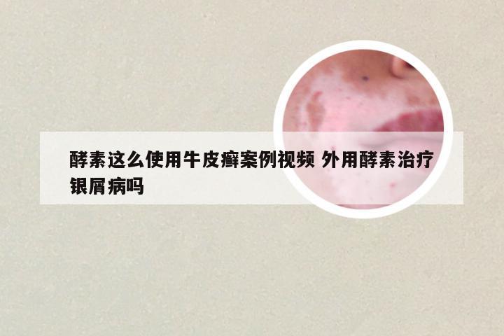酵素这么使用牛皮癣案例视频 外用酵素治疗银屑病吗
