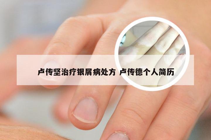 卢传坚治疗银屑病处方 卢传德个人简历