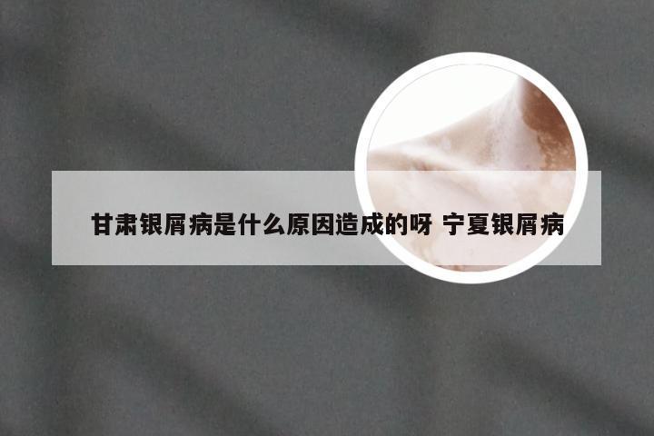 甘肃银屑病是什么原因造成的呀 宁夏银屑病