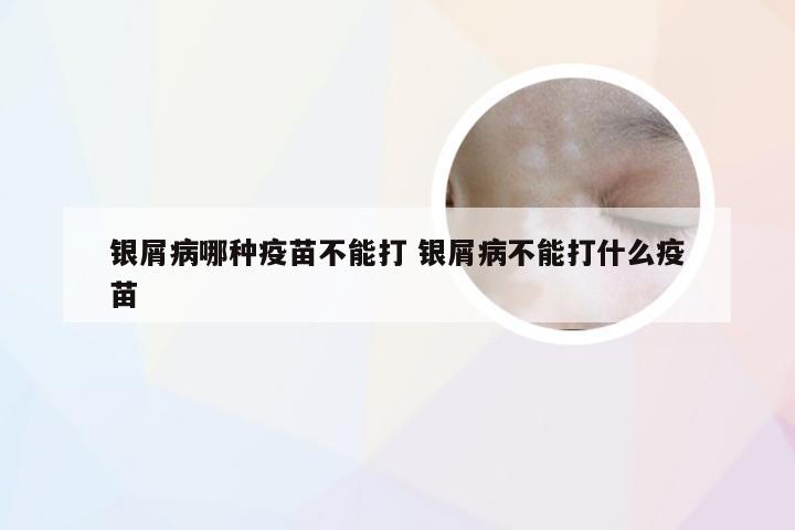 银屑病哪种疫苗不能打 银屑病不能打什么疫苗