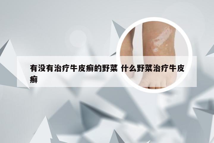 有没有治疗牛皮癣的野菜 什么野菜治疗牛皮癣