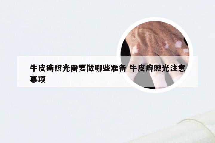 牛皮癣照光需要做哪些准备 牛皮癣照光注意事项
