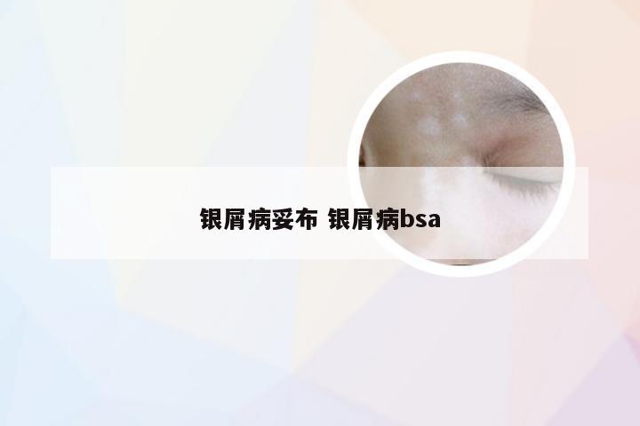银屑病妥布 银屑病bsa