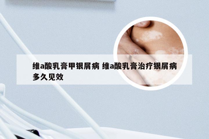 维a酸乳膏甲银屑病 维a酸乳膏治疗银屑病多久见效