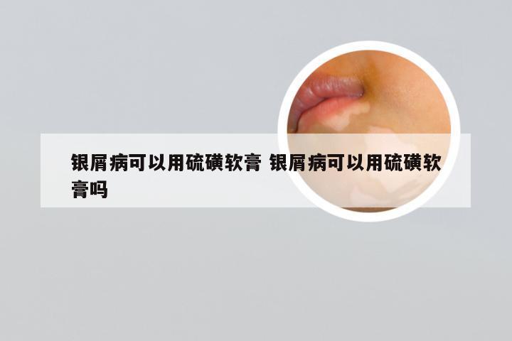 银屑病可以用硫磺软膏 银屑病可以用硫磺软膏吗