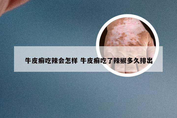 牛皮癣吃辣会怎样 牛皮癣吃了辣椒多久排出