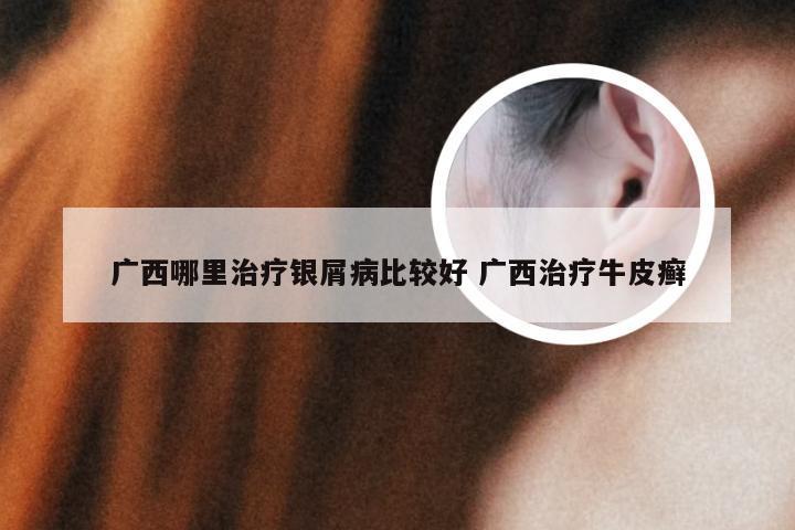 广西哪里治疗银屑病比较好 广西治疗牛皮癣