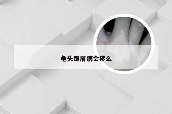 龟头银屑病会疼么