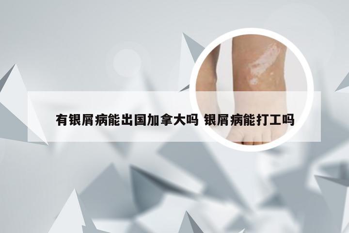 有银屑病能出国加拿大吗 银屑病能打工吗