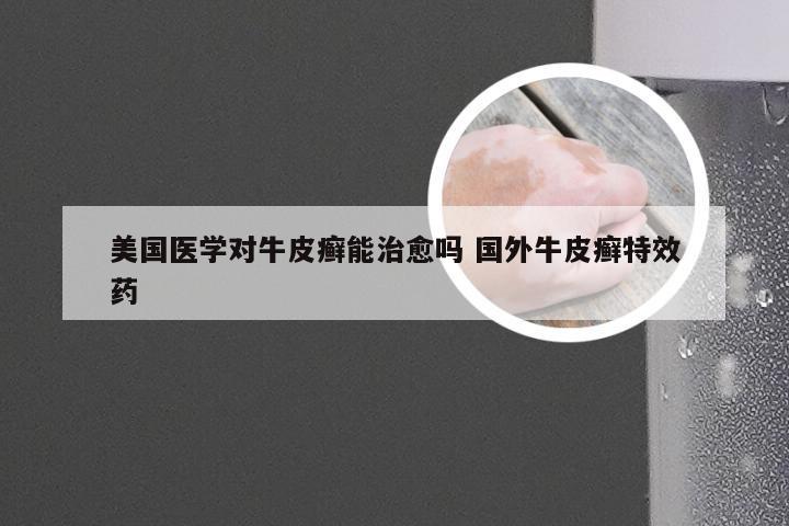 美国医学对牛皮癣能治愈吗 国外牛皮癣特效药