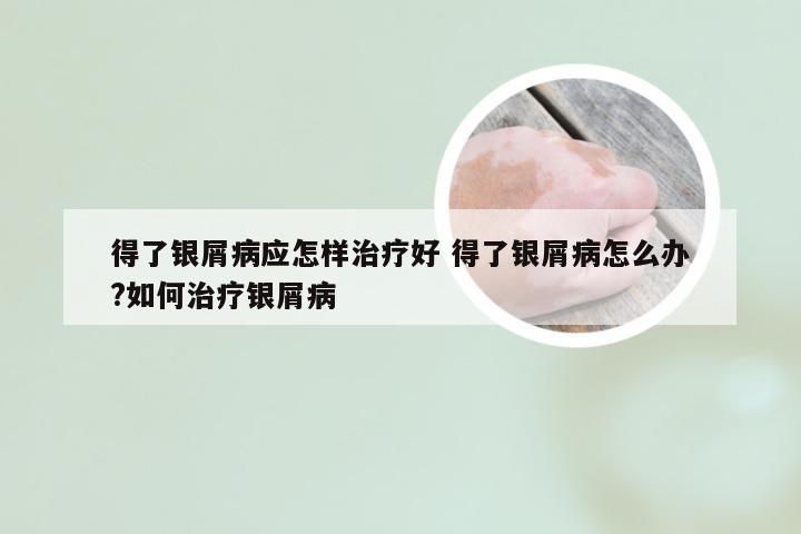 得了银屑病应怎样治疗好 得了银屑病怎么办?如何治疗银屑病