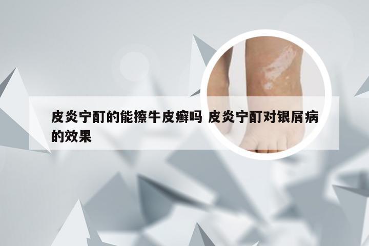 皮炎宁酊的能擦牛皮癣吗 皮炎宁酊对银屑病的效果