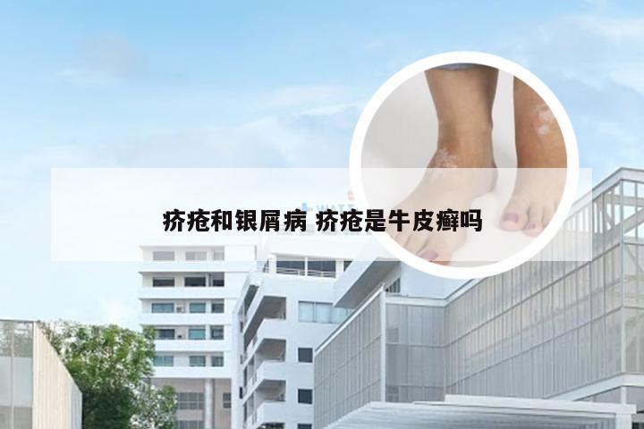 疥疮和银屑病 疥疮是牛皮癣吗
