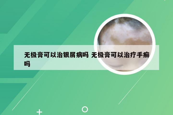 无极膏可以治银屑病吗 无极膏可以治疗手癣吗