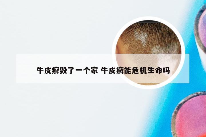 牛皮癣毁了一个家 牛皮癣能危机生命吗