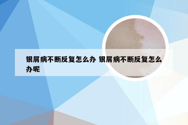 银屑病不断反复怎么办 银屑病不断反复怎么办呢