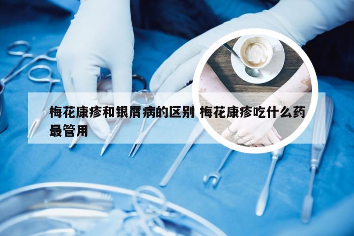 梅花康疹和银屑病的区别 梅花康疹吃什么药最管用