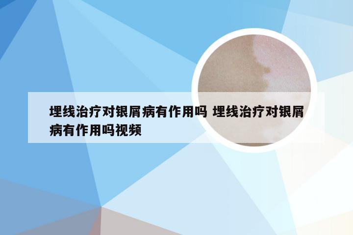 埋线治疗对银屑病有作用吗 埋线治疗对银屑病有作用吗视频
