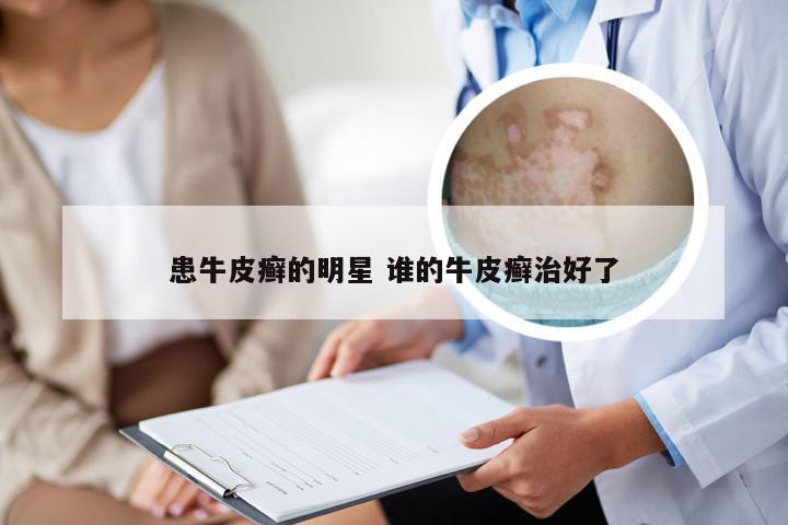 患牛皮癣的明星 谁的牛皮癣治好了