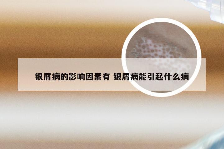 银屑病的影响因素有 银屑病能引起什么病