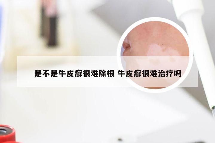 是不是牛皮癣很难除根 牛皮癣很难治疗吗