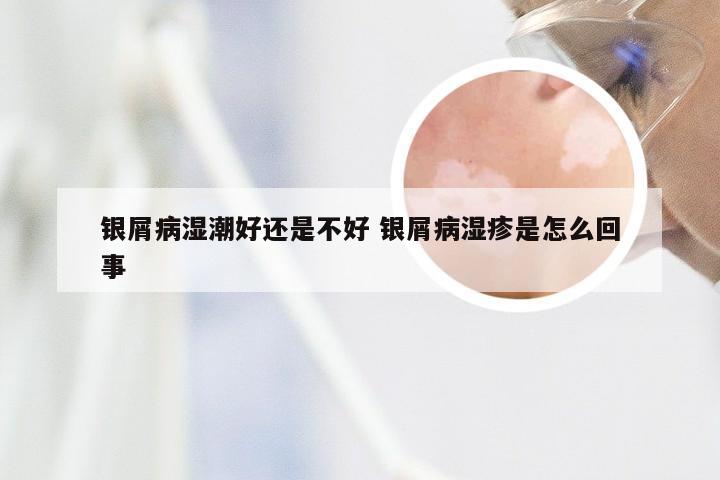 银屑病湿潮好还是不好 银屑病湿疹是怎么回事
