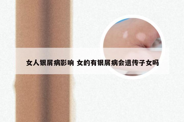 女人银屑病影响 女的有银屑病会遗传子女吗