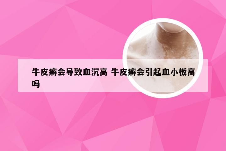 牛皮癣会导致血沉高 牛皮癣会引起血小板高吗