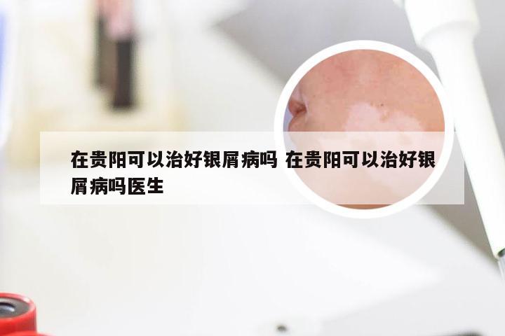 在贵阳可以治好银屑病吗 在贵阳可以治好银屑病吗医生
