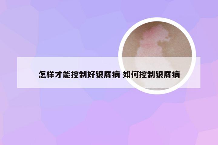 怎样才能控制好银屑病 如何控制银屑病