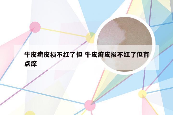 牛皮癣皮损不红了但 牛皮癣皮损不红了但有点痒