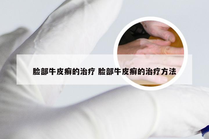脸部牛皮癣的治疗 脸部牛皮癣的治疗方法