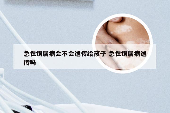 急性银屑病会不会遗传给孩子 急性银屑病遗传吗