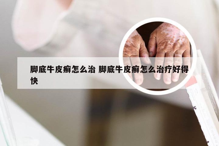 脚底牛皮癣怎么治 脚底牛皮癣怎么治疗好得快