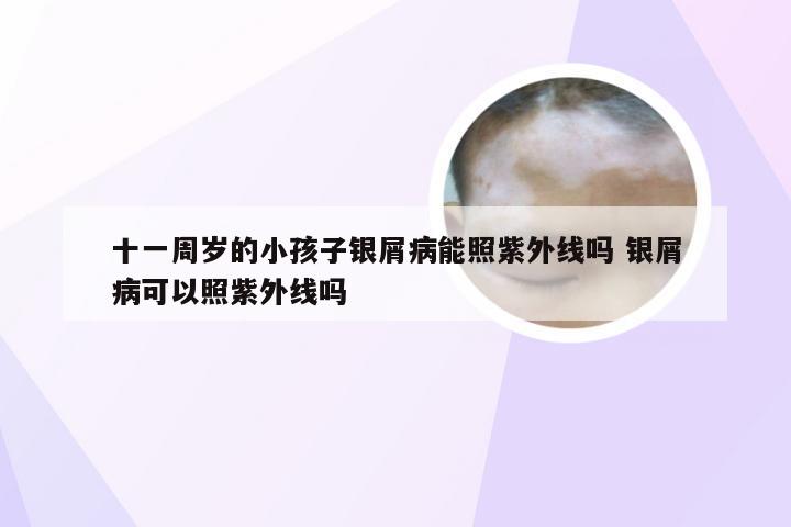 十一周岁的小孩子银屑病能照紫外线吗 银屑病可以照紫外线吗