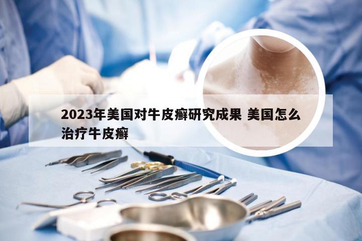 2023年美国对牛皮癣研究成果 美国怎么治疗牛皮癣