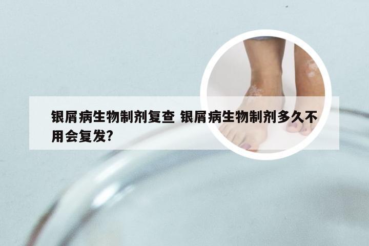 银屑病生物制剂复查 银屑病生物制剂多久不用会复发?