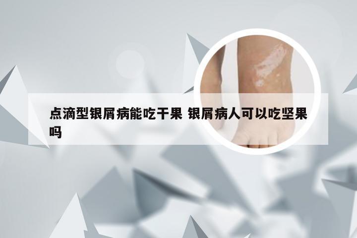 点滴型银屑病能吃干果 银屑病人可以吃坚果吗