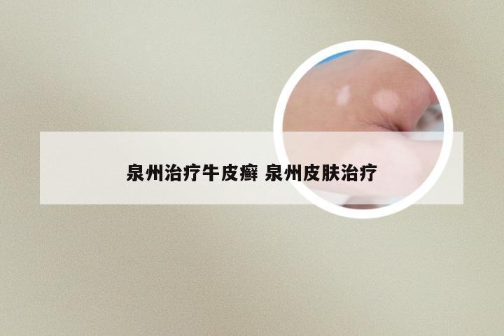 泉州治疗牛皮癣 泉州皮肤治疗
