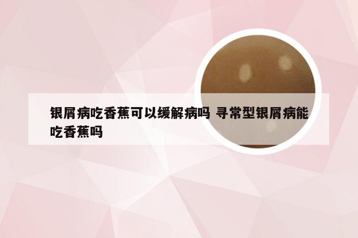 银屑病吃香蕉可以缓解病吗 寻常型银屑病能吃香蕉吗