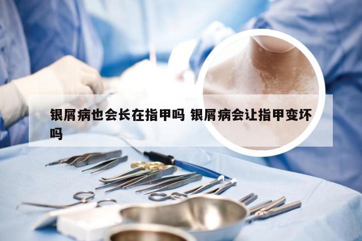 银屑病也会长在指甲吗 银屑病会让指甲变坏吗